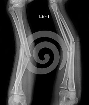 Fracture shaft of radius & ulnar bone