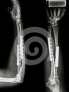 Fracture shaft of radius & ulnar bone.