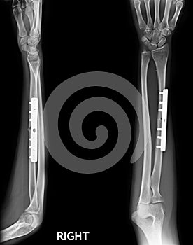 Fracture shaft of radius & ulnar bone photo