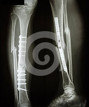 Fracture shaft of tibia and fibular (leg's bone) photo