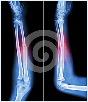 Fracture shaft of ulnar bone ( forearm bone ) : ( front and side view ) photo