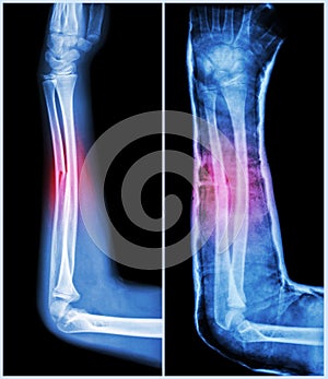 Fracture shaft of ulnar bone ( forearm bone ) : ( Left : pre-treatment , Right : Psot-treatment (splint with cast) )