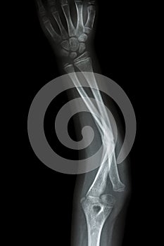 Fracture shaft of ulnar(forearm's bone) photo