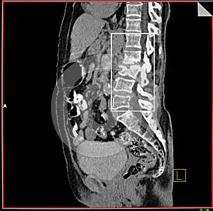 Fracture spine. Osteoporosis. CT reconstruction