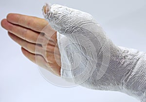 Fracture of the thumb due to an accident