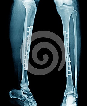 Fracture tibia bone with post op fixation