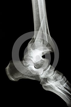 Fracture tibia & fibula (leg's bone) and ankle dislocation photo
