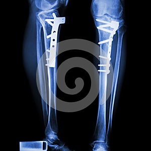 Fracture tibia(leg bone). It was operated and internal fixed