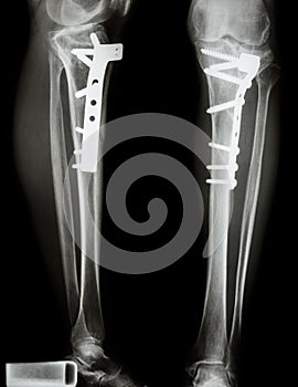 Fracture tibia(leg bone) photo