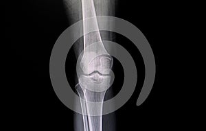 fracture tibial plateau photo