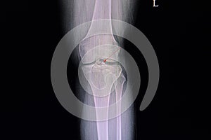 fracture tibial spine film