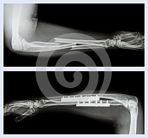 Fracture ulnar and radius (Forearm bone)