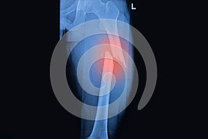 Fractured Femur, Broken thigh x-rays photo