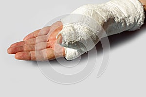 Fractured hand with the orthopedic cast after the accident on wh