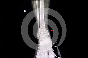 fractured lateral malleolus photo