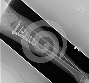 Fractured Leg bones