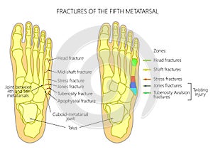 Fractures of the 5th metatarsal