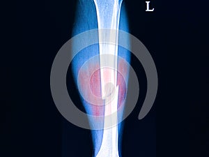 fractures of leg bones