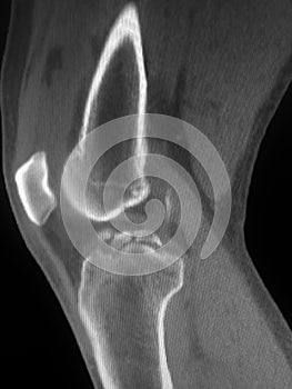 Fractures tibial spine ct scan photo