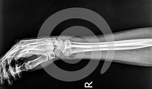 Fractures to the radius born of the right arm on an X-ray