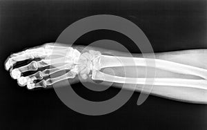 Fractures to the radius born of the right arm on an X-ray