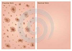 Freckle skin texture graphic