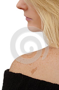 Freckles & Birth mark photo