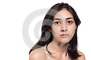 Freckles, blemish, pimple, acne and dull skin on her beautiful asian face. Asian woman gets sad, beautiful young woman get problem