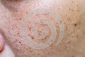 Freckles Over Asian Woman Face,Skin Problems