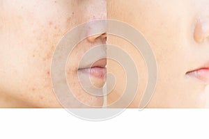 Freckles  Woman  and skin problems  Facial Treatment Step