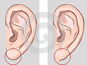 Free earlobe and attached earlobe in comparison. stock illustration photo