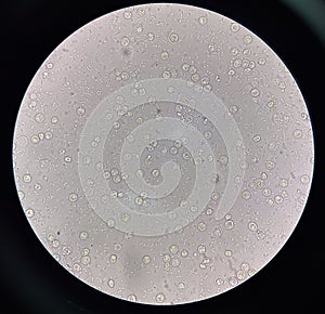 Fresh bacteria cell in urine sample