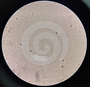 Fresh bacteria cell in urine sample
