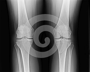 Front knee joint x-ray of mature female with osteoarthritis