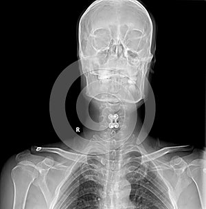 Front X-RAY IMAGE of cervical spondylosis