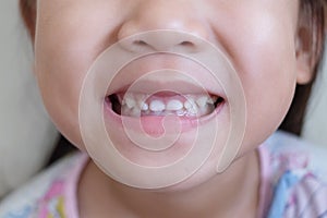 Front teeth of child girl. Little girl`s smile. 3 year old