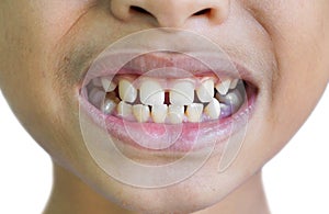 Front teeth gaps