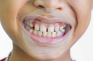 Front teeth gaps