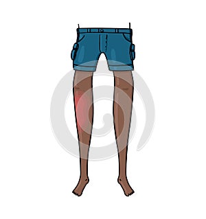 Front view of a bruised dark skin leg illustration