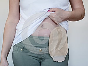 Front view on colostomy pouch in skin color attached to woman patient. Close-up on ostomy bag after surgery