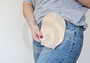 Front view on colostomy pouch in skin color attached to young woman patient. Close-up on ostomy bag after surgery