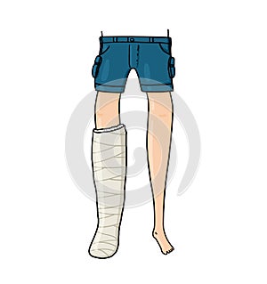 Front view of light skin leg in cast illustration