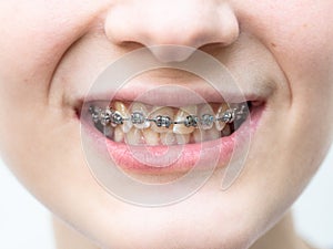 Front view of orthodontic dental braces on teeth