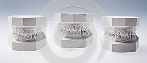 Front view of a plaster study models