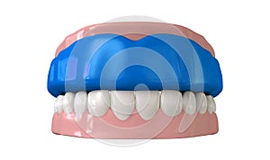 Gum Guard Fitted On Closed False Teeth