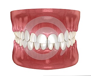 Frontal crown lengthening, Esthetic surgery. Medically accurate dental 3D illustration