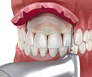 Frontal crown lengthening, Esthetic surgery. Medically accurate dental 3D illustration