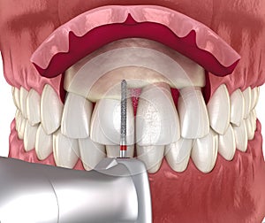 Frontal crown lengthening, Esthetic surgery. Medically accurate dental 3D illustration