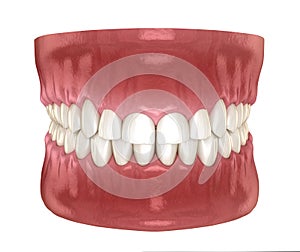 Frontal crown lengthening, Esthetic surgery. Medically accurate dental 3D illustration photo
