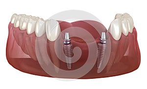 Frontal teeth bridge supported by implants. Medically accurate 3D animation of dental concept